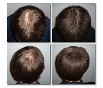 La calvície augmenta dia a dia. Qui et roba els cabells? Una lectura obligada...