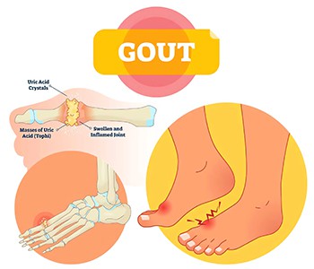 Beu cervesa i menja marisc, compte amb la gota