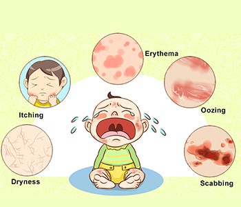 Atenció! Aneu amb compte amb la dermatitis i l'èczema a l'estiu
