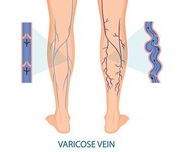 Quan s'han d'intervenir les varius? La millor opció per evitar retards